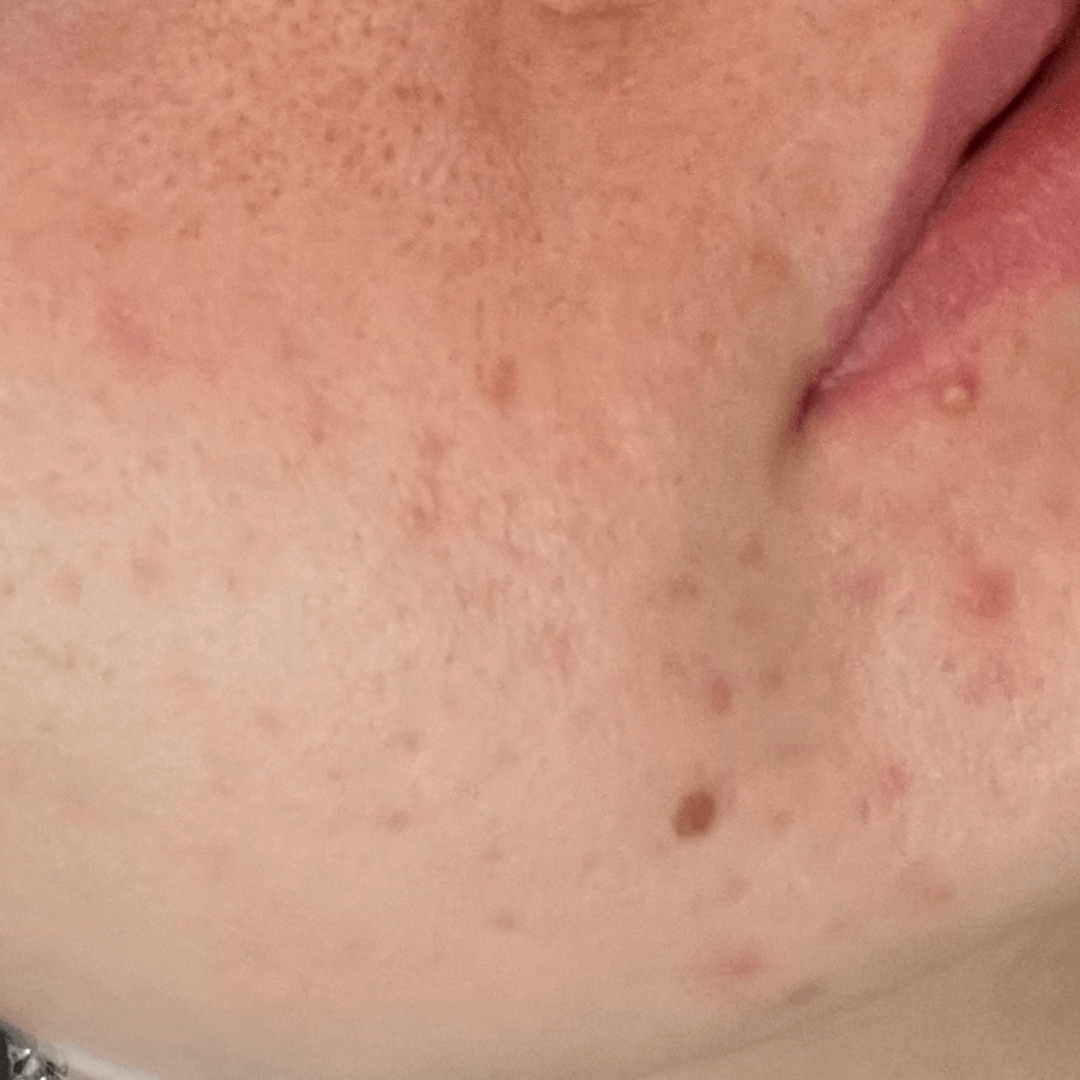 alexis-customer-after-cocoon-hormonal-acne-supplement.png__PID:72eff9b9-dafe-4910-b600-d68a927085bc