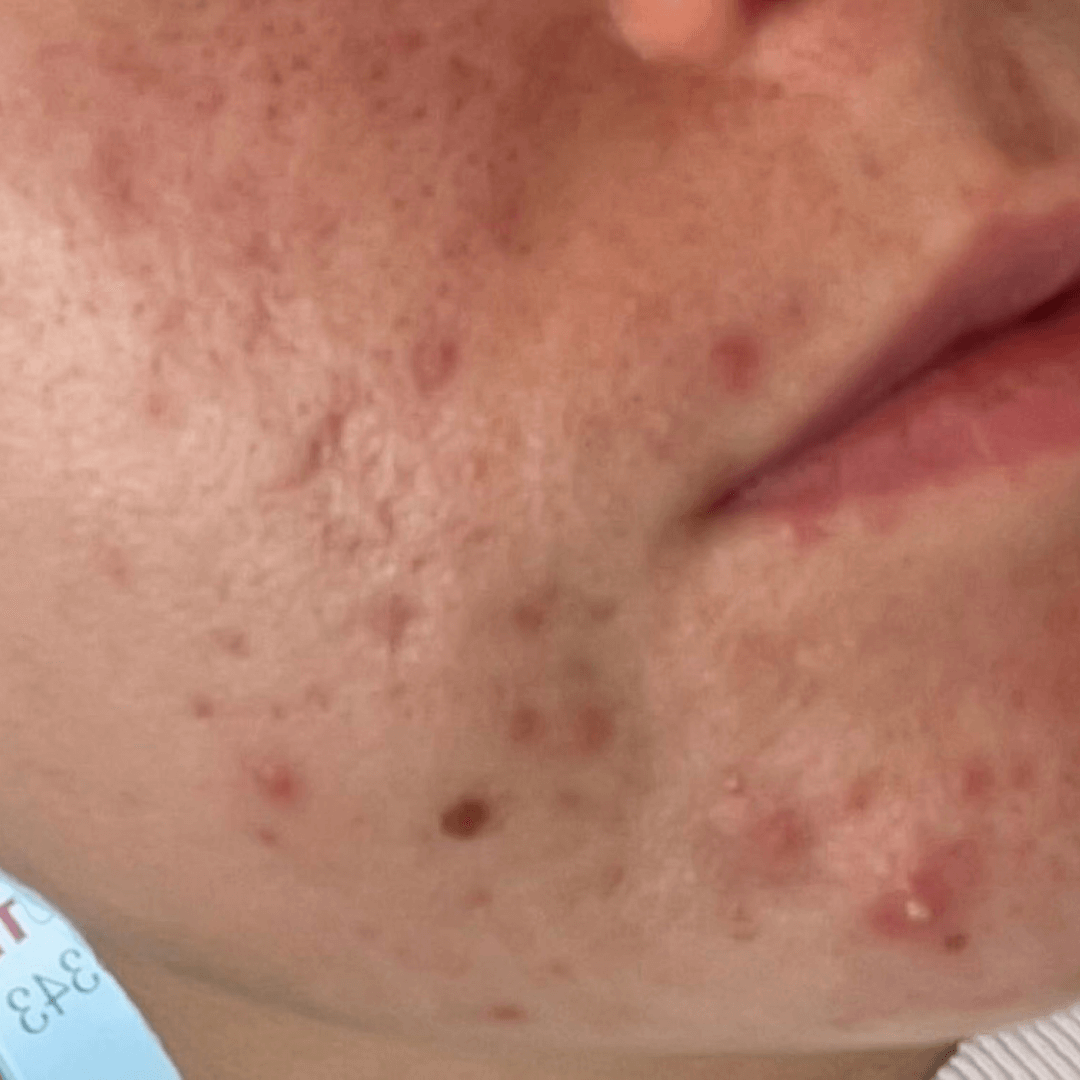 alexis-customer-before-cocoon-hormonal-acne-supplement.png__PID:93e572ef-f9b9-4afe-8910-3600d68a9270