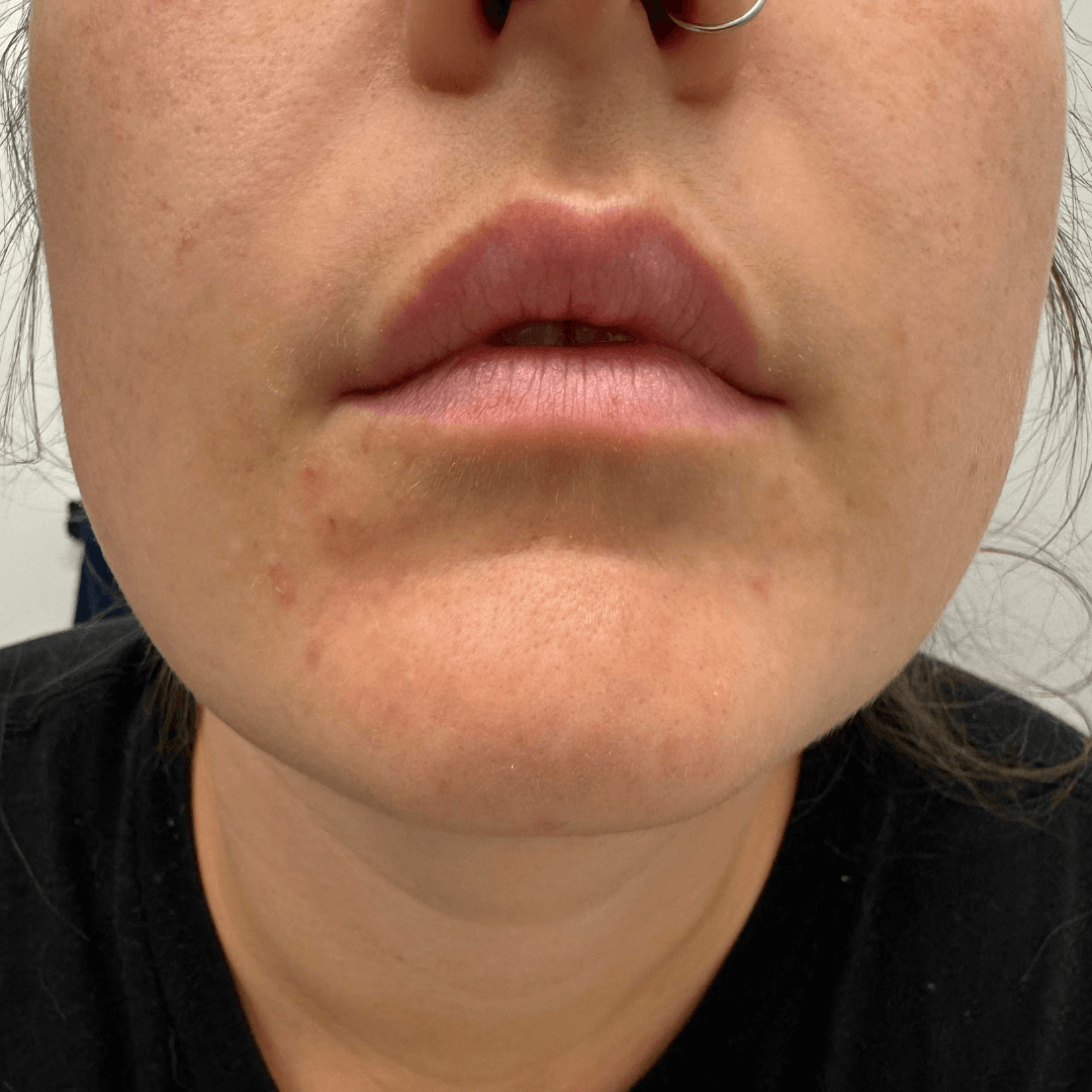 hailee-customer-after-cocoon-hormonal-acne-supplement.png__PID:4551fc56-c41a-44a8-af8c-8a6047b33b65