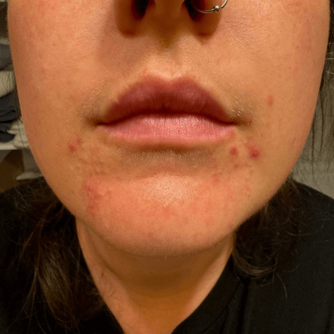 hailee-customer-before-cocoon-hormonal-acne-supplement.png__PID:fc56c41a-f4a8-4f8c-8a60-47b33b65612a