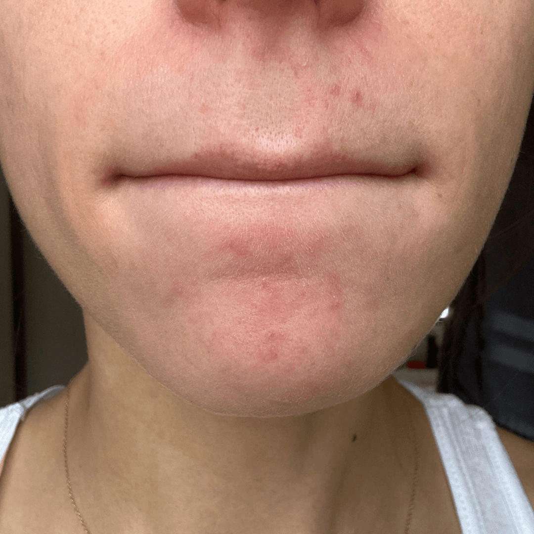 karley-customer-after-cocoon-hormonal-acne-supplement.png__PID:f4a8ef8c-8a60-47b3-bb65-612a93e572ef