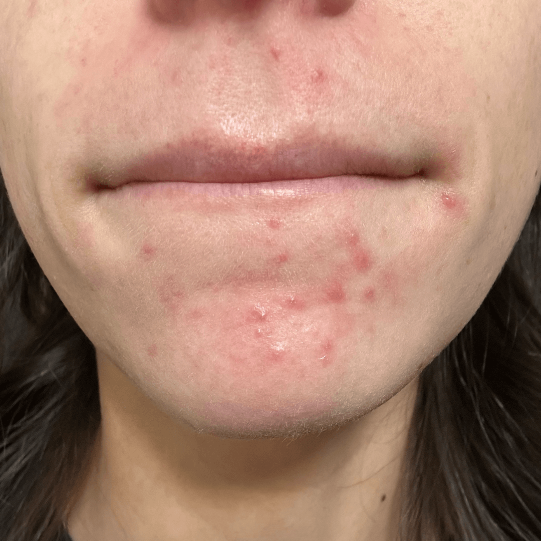 karley-customer-before-cocoon-hormonal-acne-supplement.png__PID:c41af4a8-ef8c-4a60-87b3-3b65612a93e5