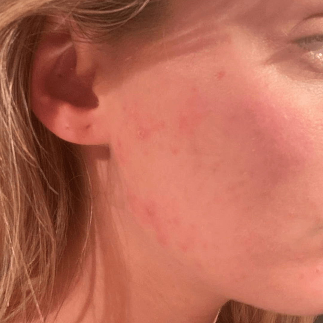 kim-customer-after-cocoon-hormonal-acne-supplement-1.png__PID:3b65612a-93e5-42ef-b9b9-dafec9103600