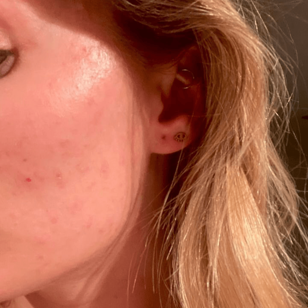kim-customer-after-cocoon-hormonal-acne-supplement-2.png__PID:612a93e5-72ef-49b9-9afe-c9103600d68a