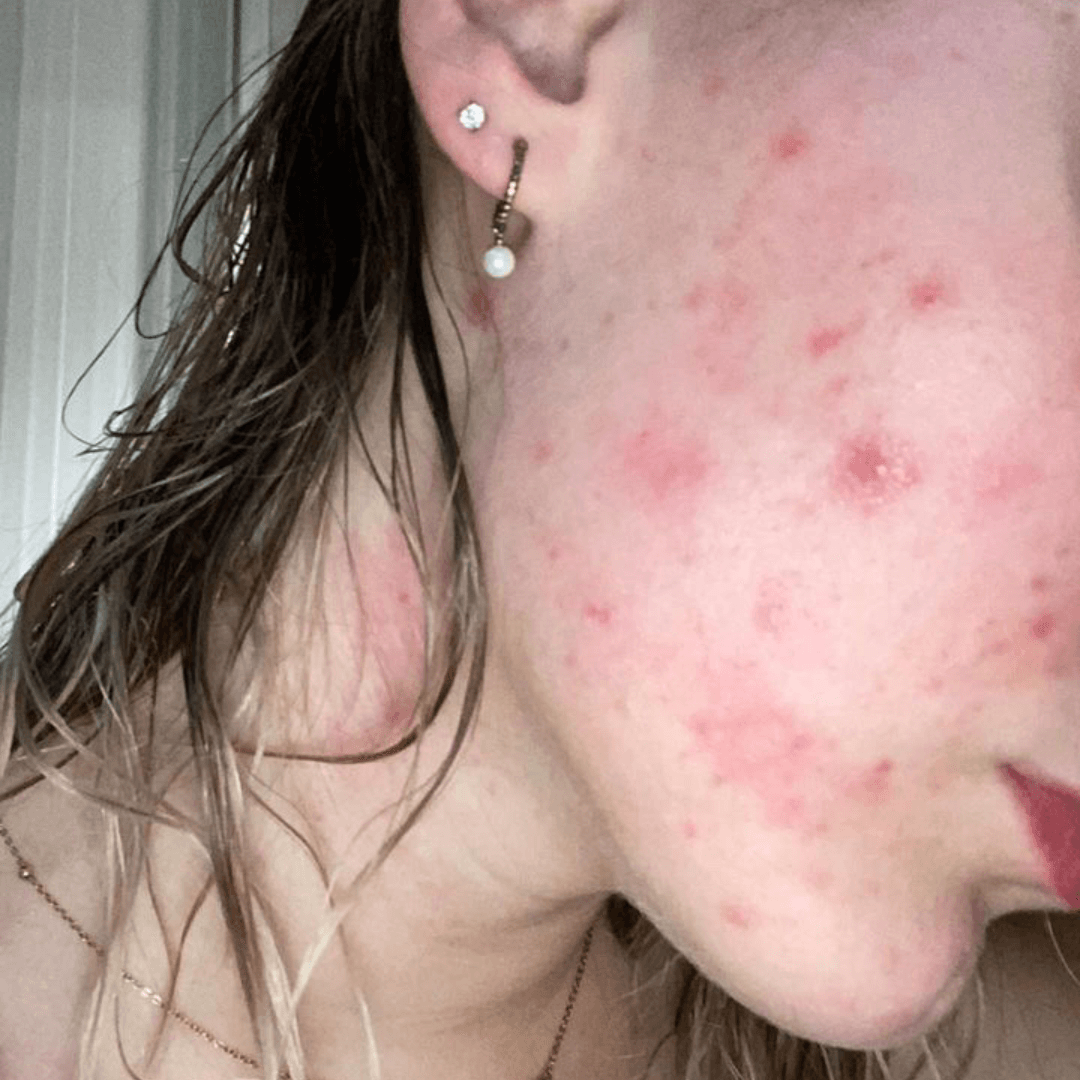 kim-customer-before-cocoon-hormonal-acne-supplement-1.png__PID:ef8c8a60-47b3-4b65-a12a-93e572eff9b9