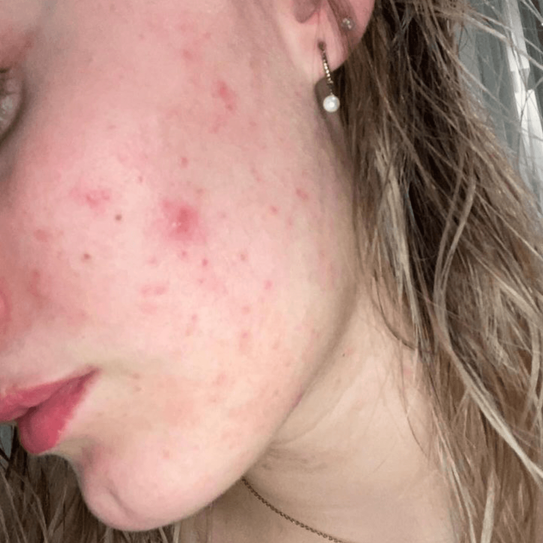 kim-customer-before-cocoon-hormonal-acne-supplement-2.png__PID:47b33b65-612a-43e5-b2ef-f9b9dafec910