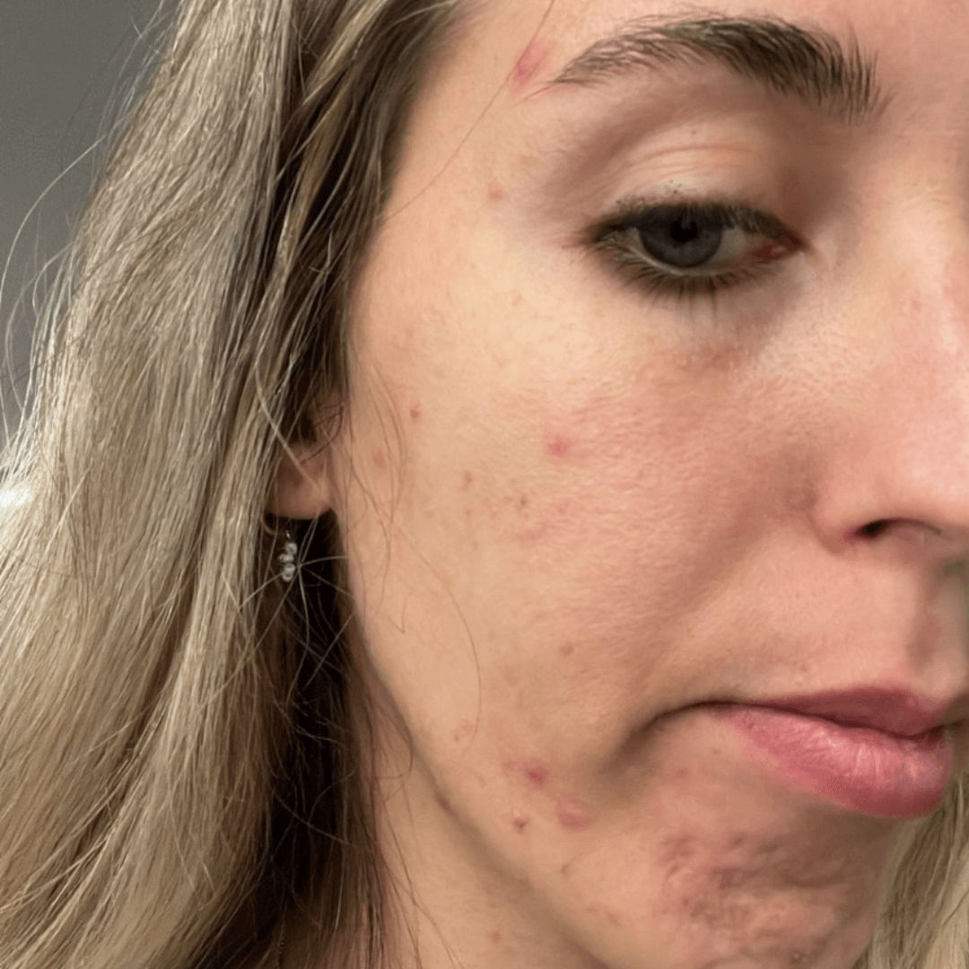 paloma-customer-before-cocoon-hormonal-acne-supplement.png__PID:f9b9dafe-c910-4600-968a-927085bcef0e