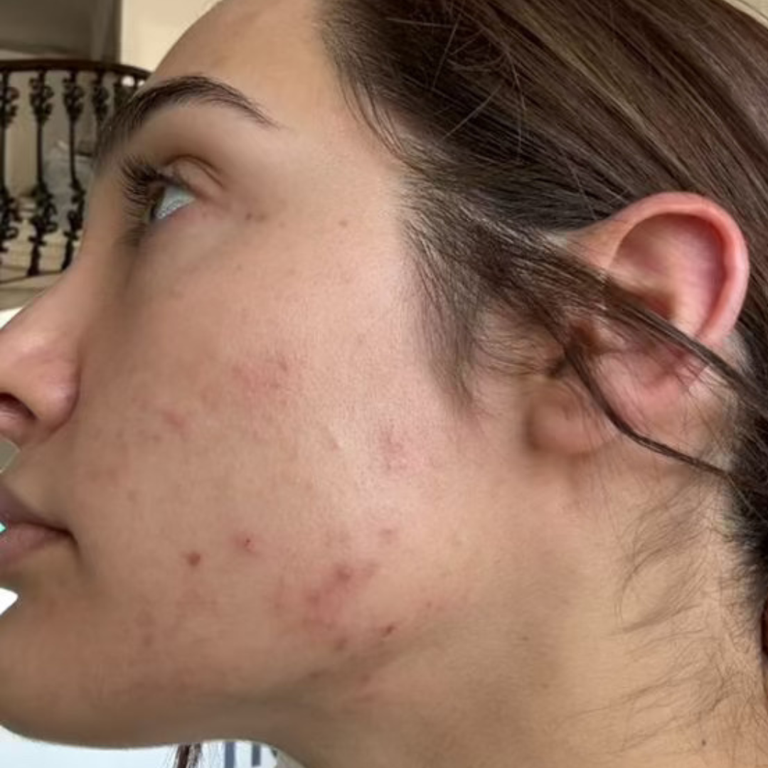 paulina-customer-before-cocoon-hormonal-acne-supplement.png__PID:b9e096d5-56b1-4e7d-880d-f30aa3efad16