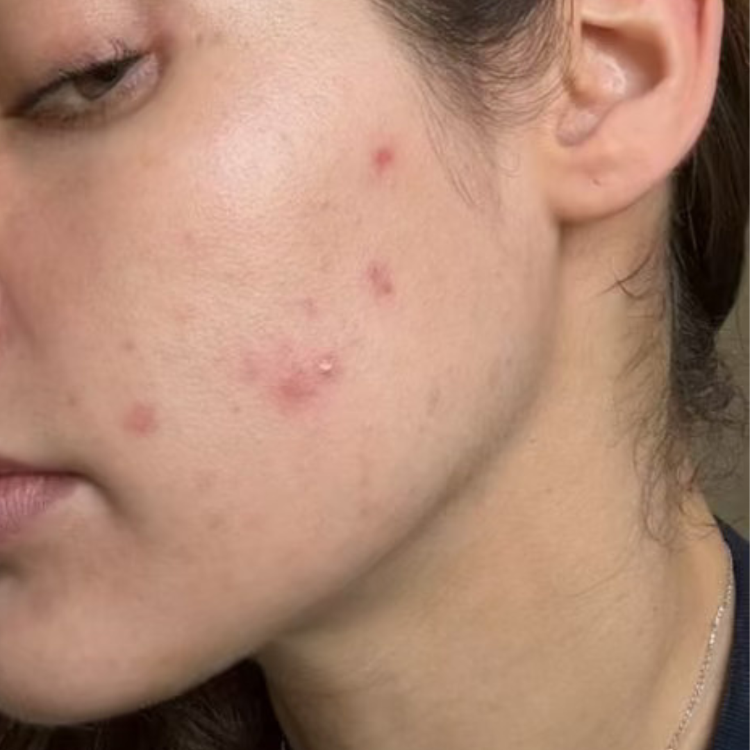 paulina-customer-month-1-cocoon-hormonal-acne-supplement.png__PID:de7d080d-f30a-43ef-ad16-4ae0537c4a33