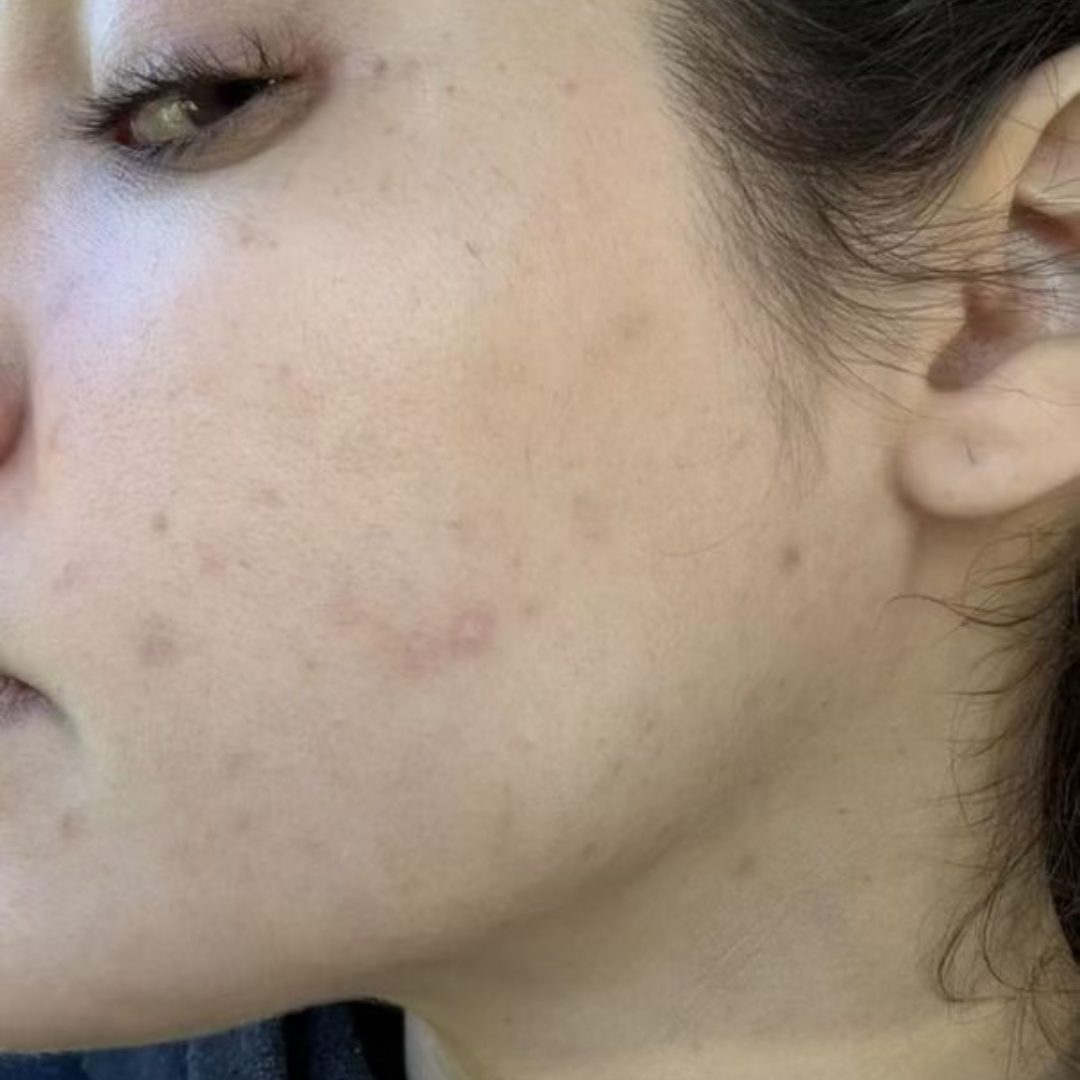 paulina-customer-month-2-cocoon-hormonal-acne-supplement.png__PID:080df30a-a3ef-4d16-8ae0-537c4a33e468